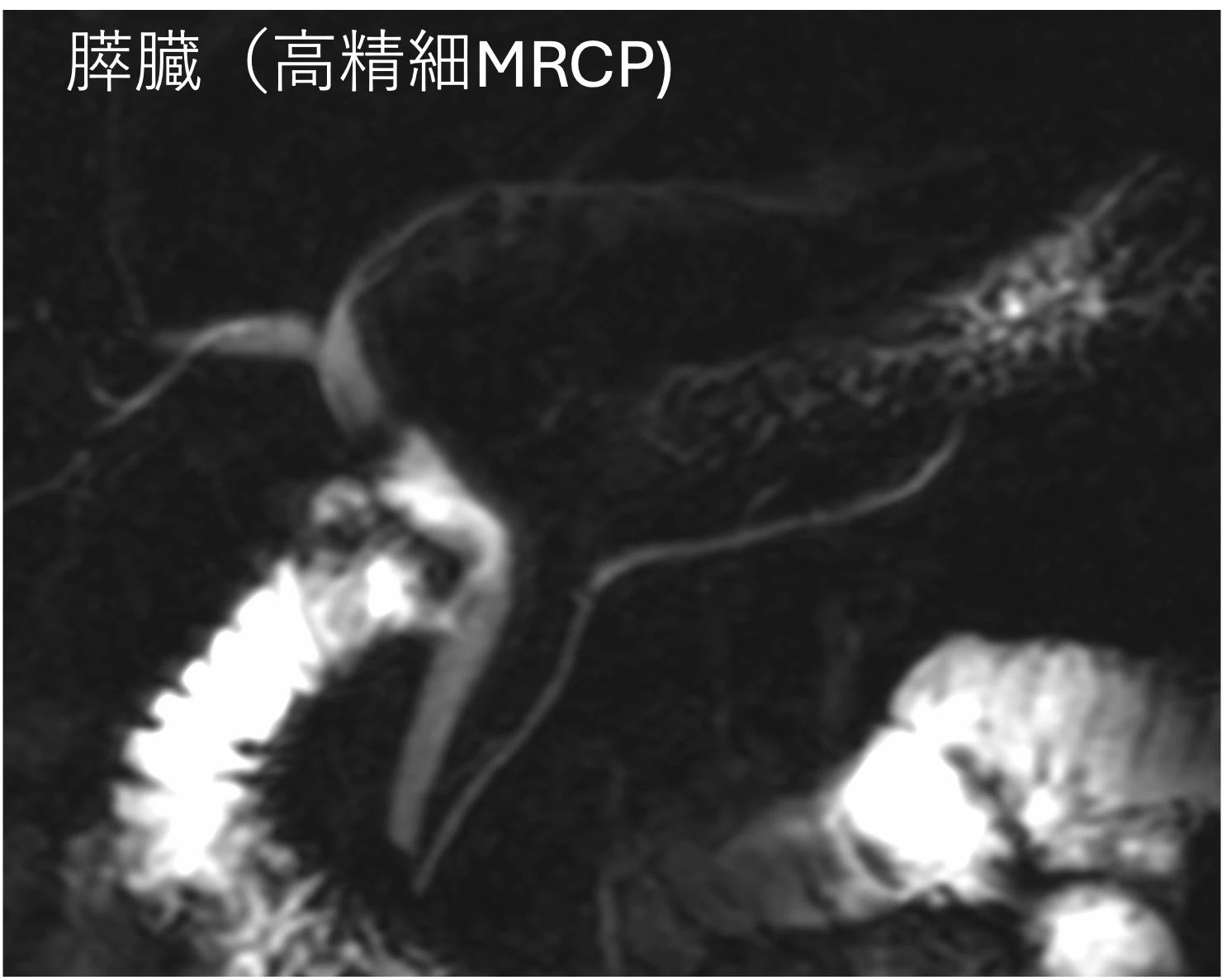 膵臓(高精細MRCP) 膵臓(高精細MRCP)