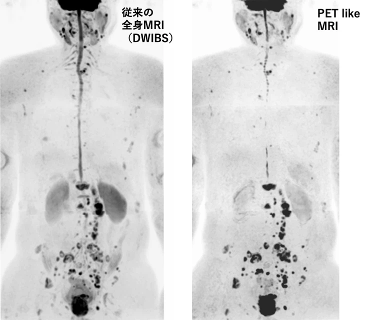 従来の全身MRIと、新しい表示(PET like MRI) 従来の全身MRIと、新しい表示(PET like MRI)